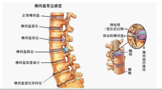 4,腰椎间盘突出是运动系统疾病,预防原则要求减少运动,放松休息