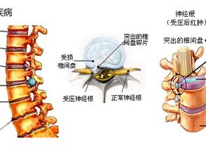 腰椎间盘突出体征