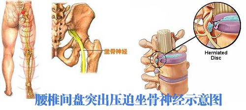 坐骨神经痛.jpg