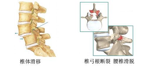 腰椎滑脱.jpg