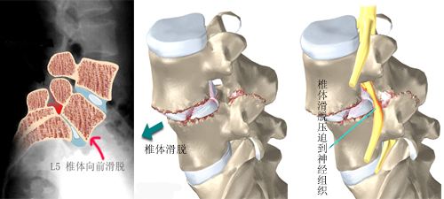 腰椎滑脱10.jpg