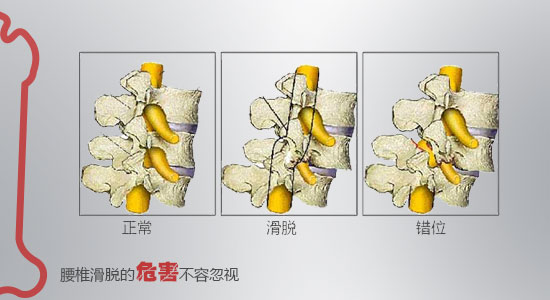 腰椎滑脱13.jpg