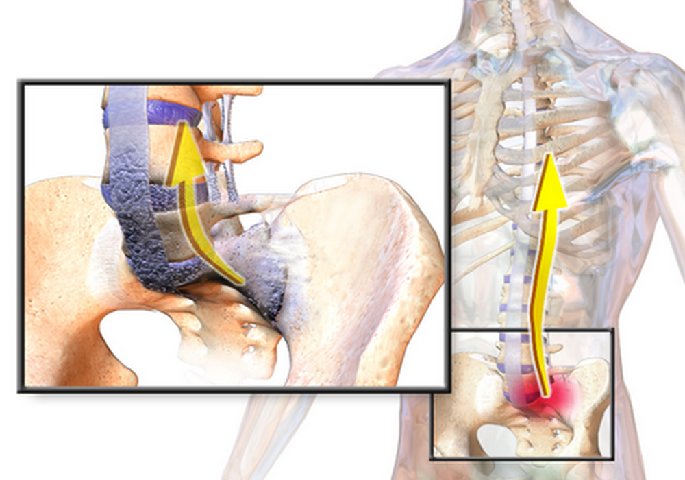 ankylosing-spondylitis