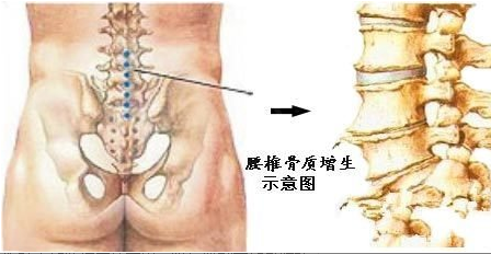 腰椎骨质增生3