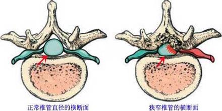 椎管狭窄1.jpg