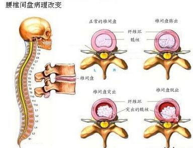 腰椎间盘病理改变.jpg