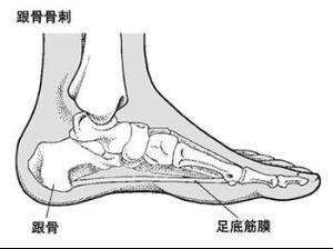 足跟骨刺