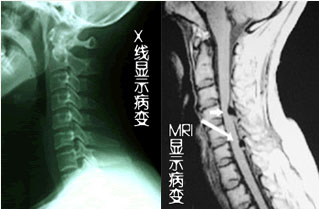 椎管狭窄5.jpg