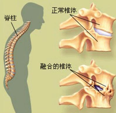 强直性脊柱炎2.jpg