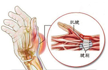 急性浆液性腱鞘炎