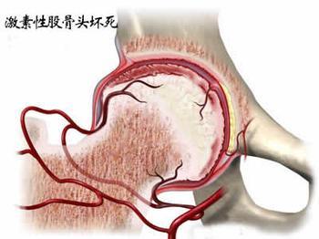 激素性股骨头坏死