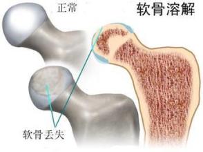 二期股骨头坏死