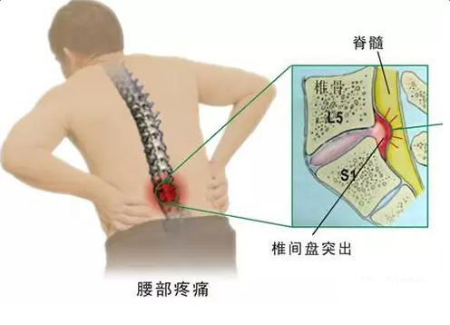 腰椎间盘突出腰痛原因