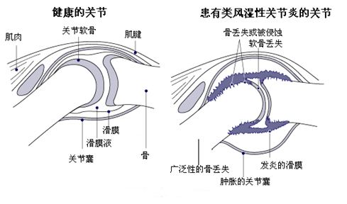 风湿1.jpg