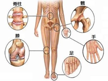 骨性关节炎6.jpg