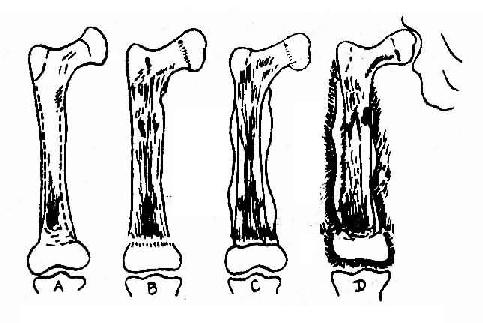 骨髓炎治疗.jpg