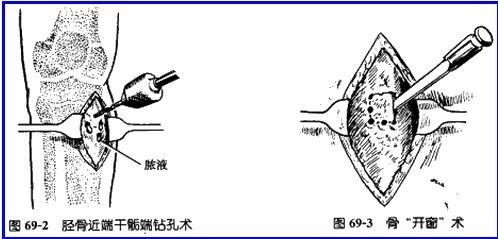 怎样预防骨髓炎.jpg