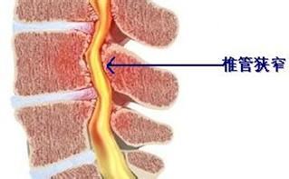 怎样预防椎管狭窄