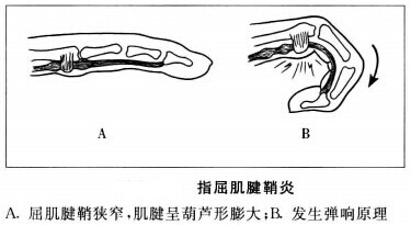 腱鞘炎.jpg