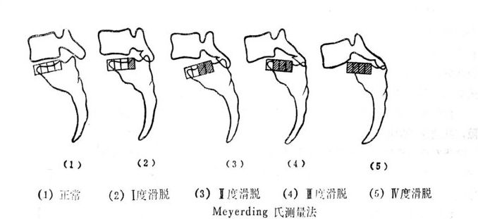 滑脱2.jpg