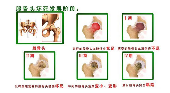 股骨头坏死发展阶段