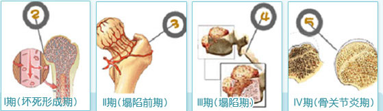 股骨头5.jpg