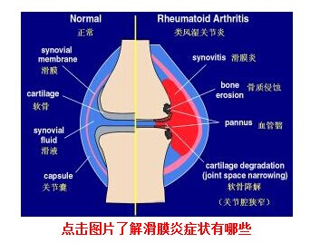 滑膜炎1.jpg