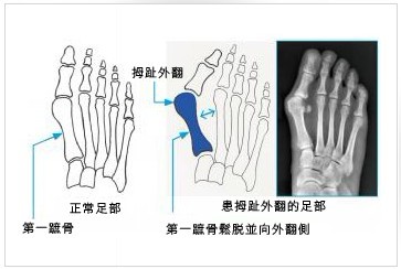 拇外翻7.jpg