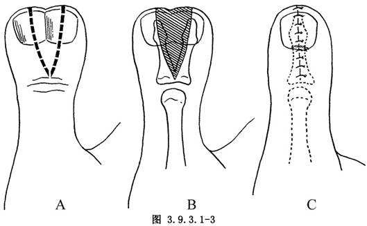 多指4.jpg