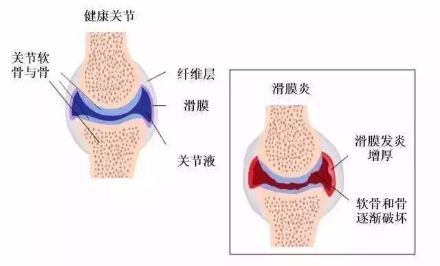 关节积液.jpg