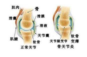 膝关节退行性病变怎么回事.jpg