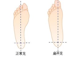 创伤性扁平足.jpg